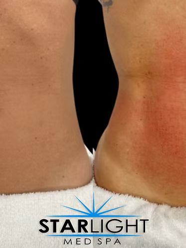 Starlight Body Contouring - 15 Mins.