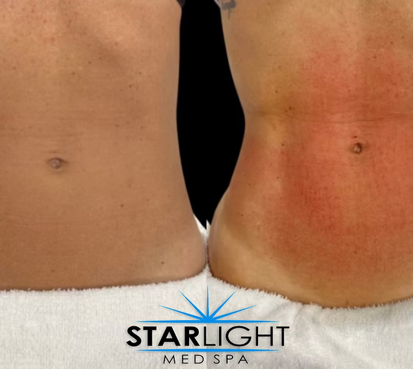 Starlight Body Contouring - 45 Mins