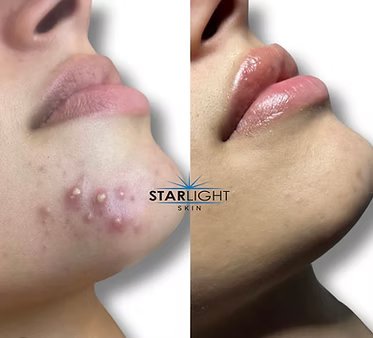 CHEMICAL PEEL