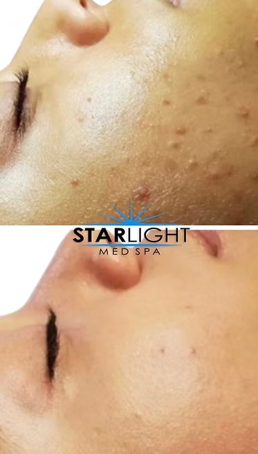 Perfect Derma Peel