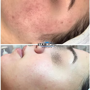 INTENSE PULSED LIGHT Therapy