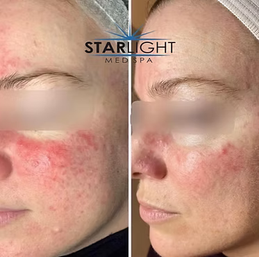 ALEX/YAG PHOTOREJUVENATION