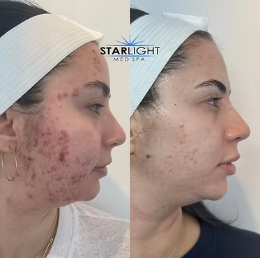 ALEX/YAG PHOTOREJUVENATION