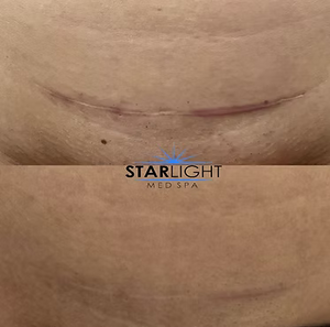 MICRONEEDLING