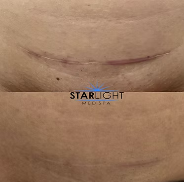 MICRONEEDLING