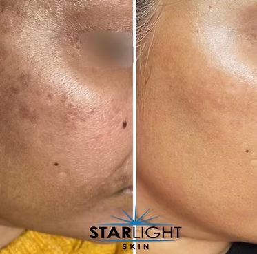 MICRONEEDLING