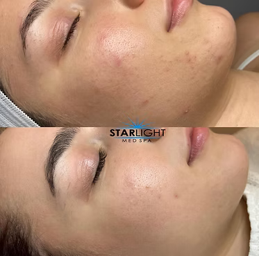 MICRONEEDLING
