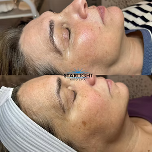 INTENSE PULSED LIGHT Therapy
