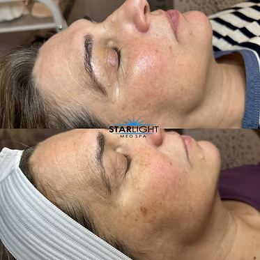 INTENSE PULSED LIGHT Therapy