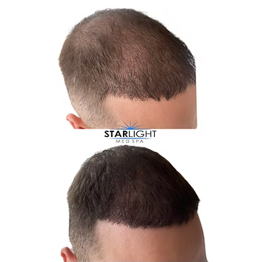 MICRONEEDLING