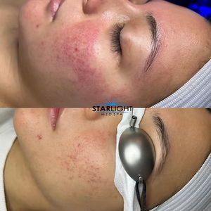 INTENSE PULSED LIGHT Therapy