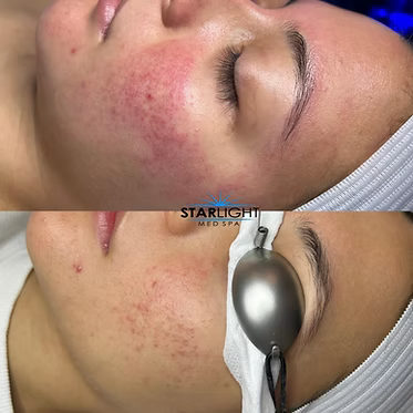 INTENSE PULSED LIGHT Therapy