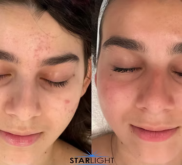 CHEMICAL PEEL