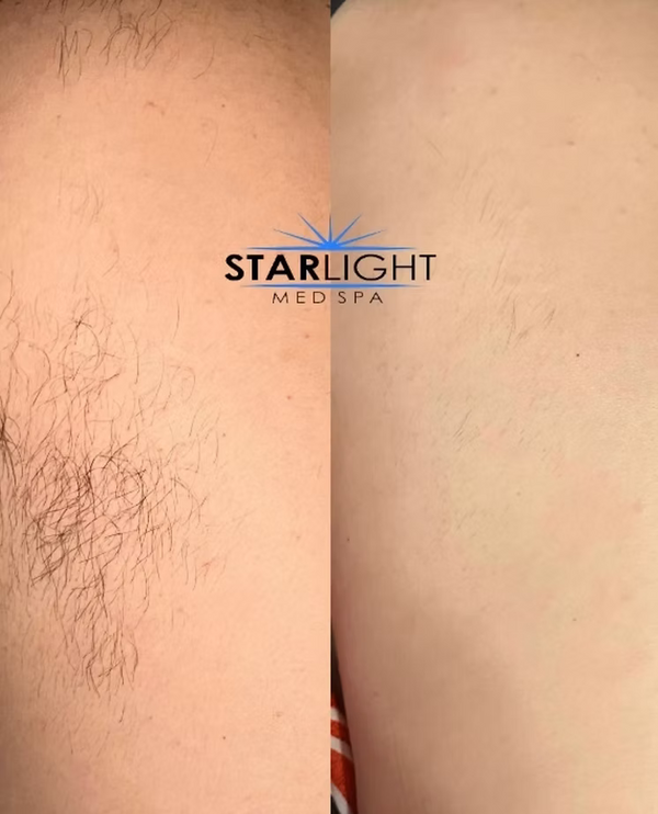 Laser Hair Removal - Large Areas