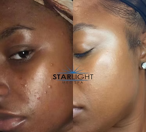 CHEMICAL PEEL