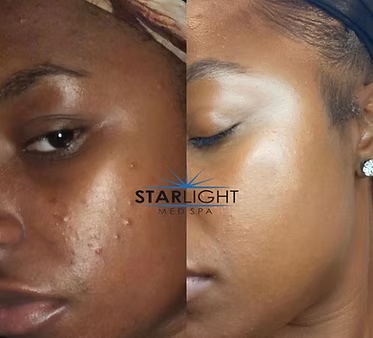 CHEMICAL PEEL