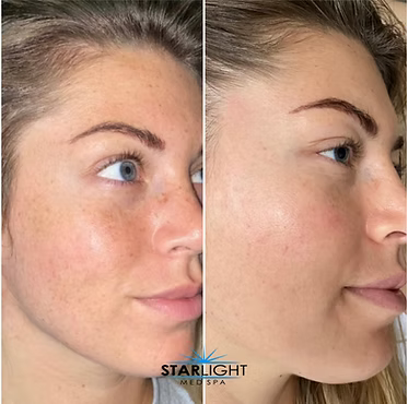 ALEX/YAG PHOTOREJUVENATION