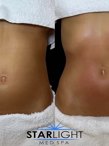 Starlight Body Contouring - 15 Mins.