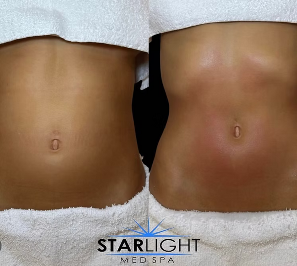 Starlight Body Contouring - 30 Mins