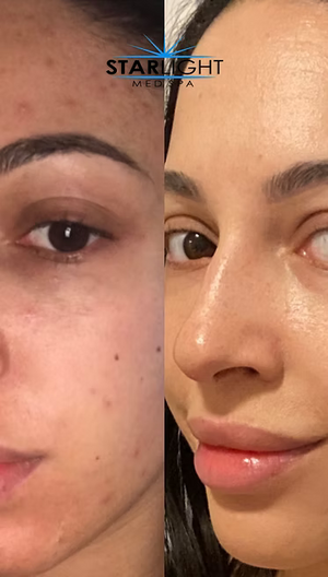 Perfect Derma Peel