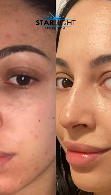 Perfect Derma Peel