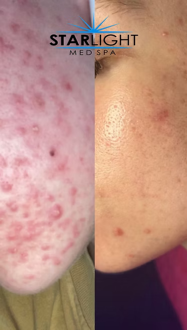 Perfect Derma Peel