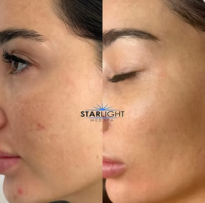MICRONEEDLING