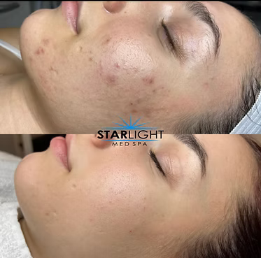 MICRONEEDLING