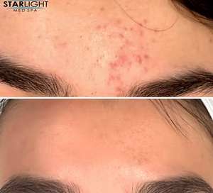 CHEMICAL PEEL