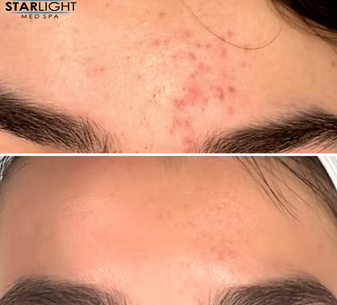 CHEMICAL PEEL