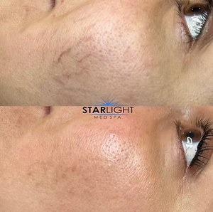 ALEX/YAG PHOTOREJUVENATION