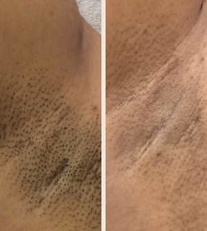 Laser Hair Removal - Medium Areas