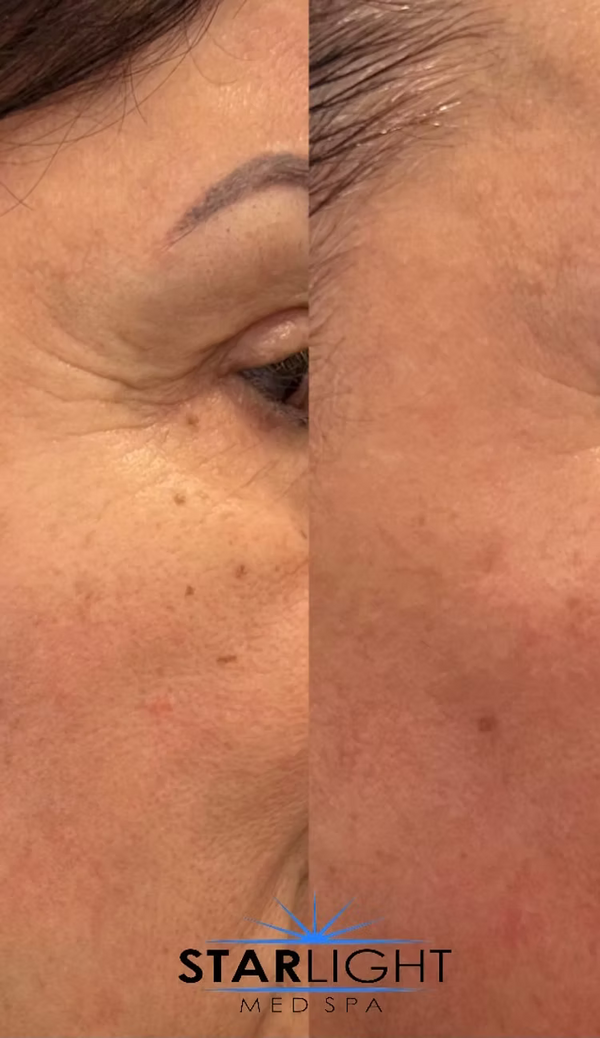 FORMA - Face or Neck