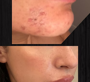 CHEMICAL PEEL