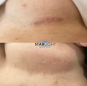 MICRONEEDLING