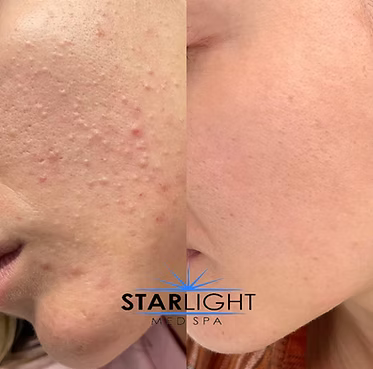 MICRONEEDLING