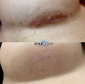 MICRONEEDLING