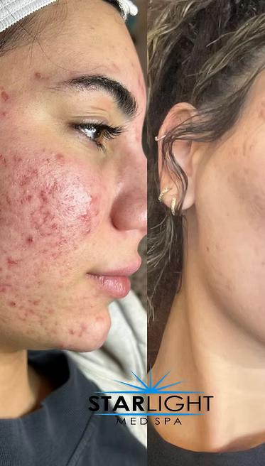 Perfect Derma Peel
