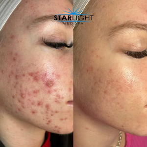 CLEARING COMPLEX Acne Serum