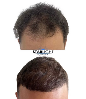 HAIR LOSS REGENERATION